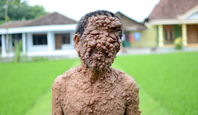 neurofibromatosis