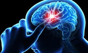 سکته مغزی stroke
