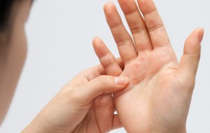 treatment-for-psoriasis