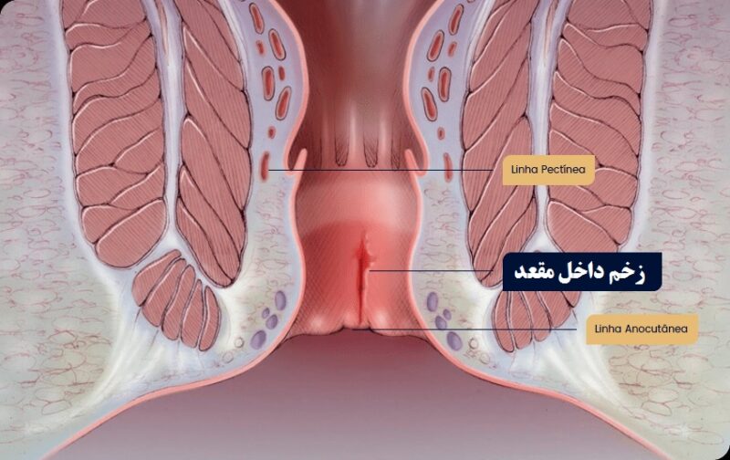 مقعدم از داخل زخم شده چیکار کنم؟