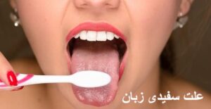 علت سفیدی زبان