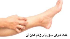 علت خارش ساق پا و زخم شدن آن