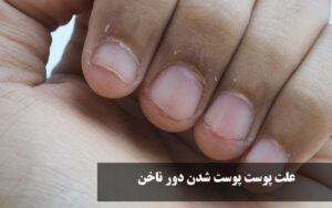 علت پوست پوست شدن دور ناخن