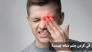 قی کردن چشم