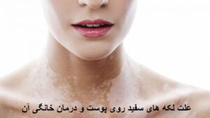 علت لکه های سفید روی پوست و درمان خانگی آن