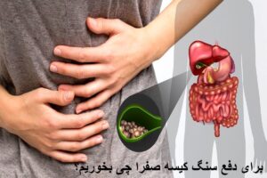 برای دفع سنگ کیسه صفرا چی بخوریم؟