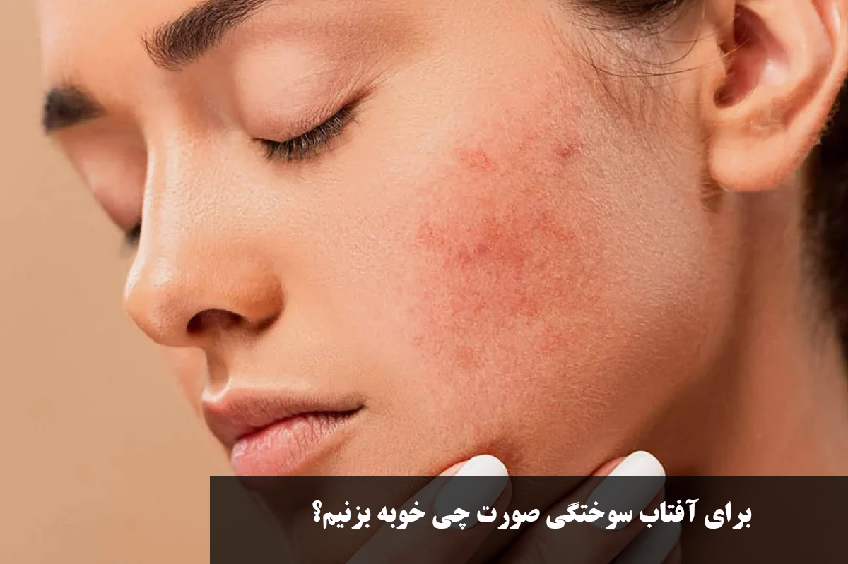 برای آفتاب سوختگی صورت چی خوبه بزنیم؟