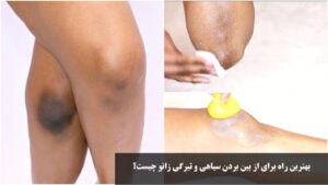 بهترین راه برای از بین بردن سیاهی و تیرگی زانو چیست؟ روش خانگی و سریع