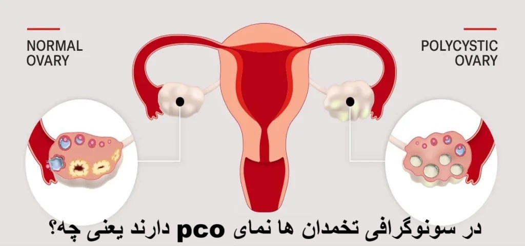 در سونوگرافی تخمدان ها نمای pco دارند یعنی چه؟