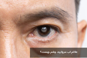 علائم اب مروارید چشم چیست؟