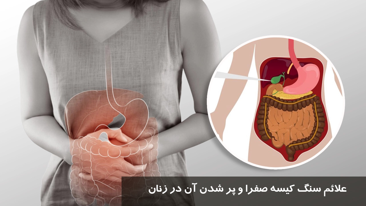 علائم سنگ کیسه صفرا