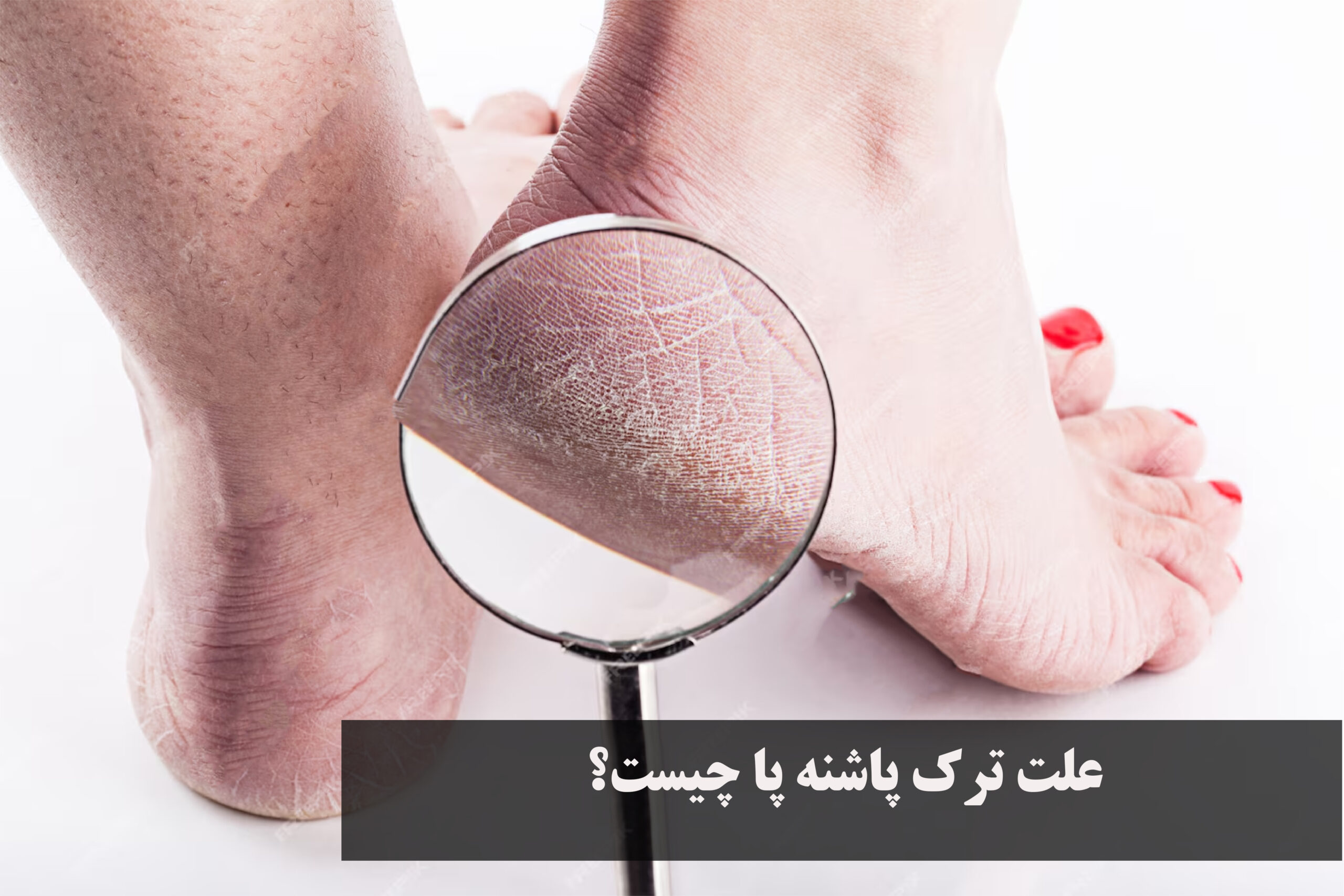 علت ترک پاشنه پا چیست؟