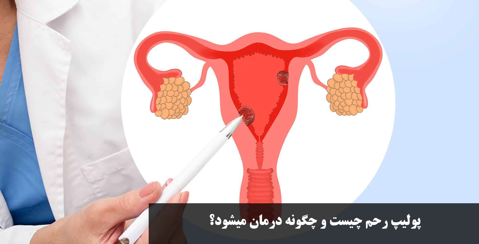 پولیپ رحم چیست و چگونه درمان میشود؟