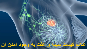 علائم كيست سينه و علت به وجود آمدن آن