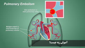 آمبولی ریه