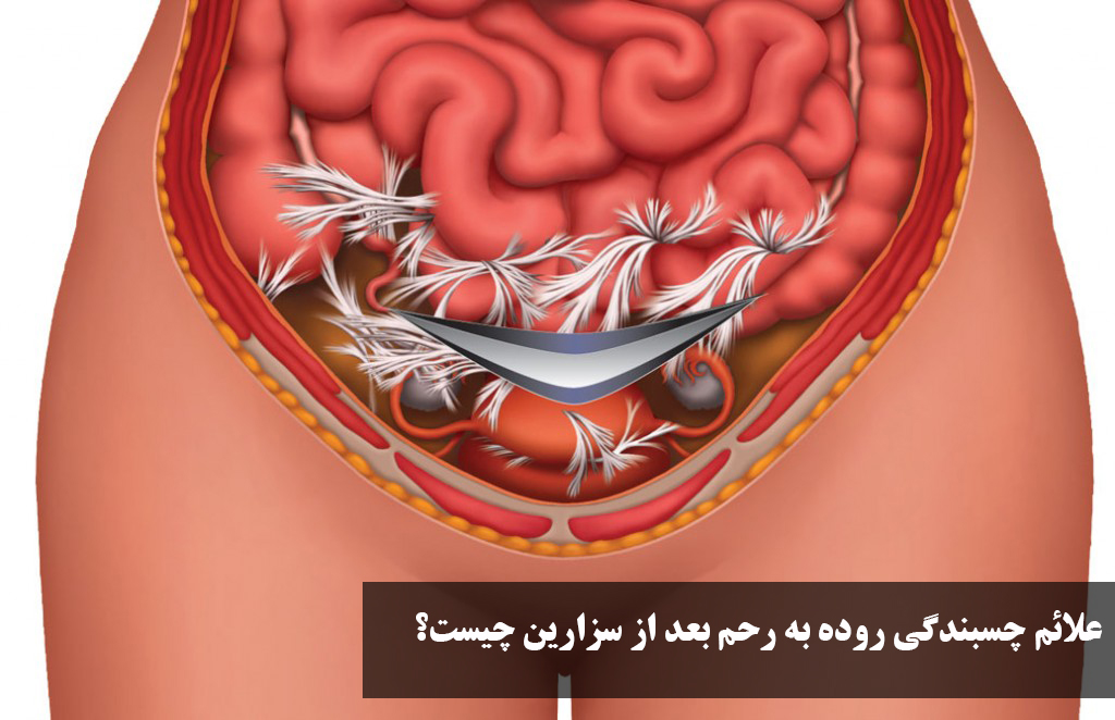 علائم چسبندگی روده به رحم بعد از سزارین چیست؟