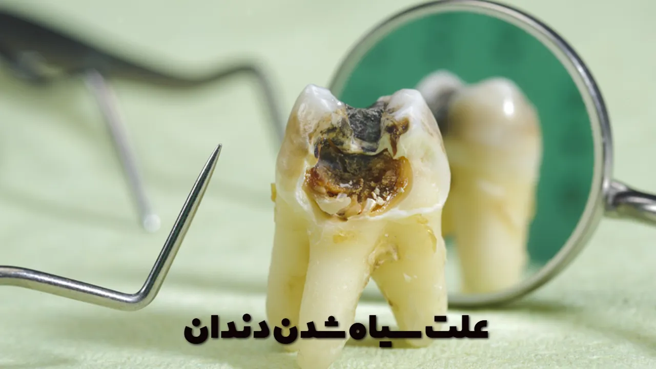 علت سیاه شدن دندان
