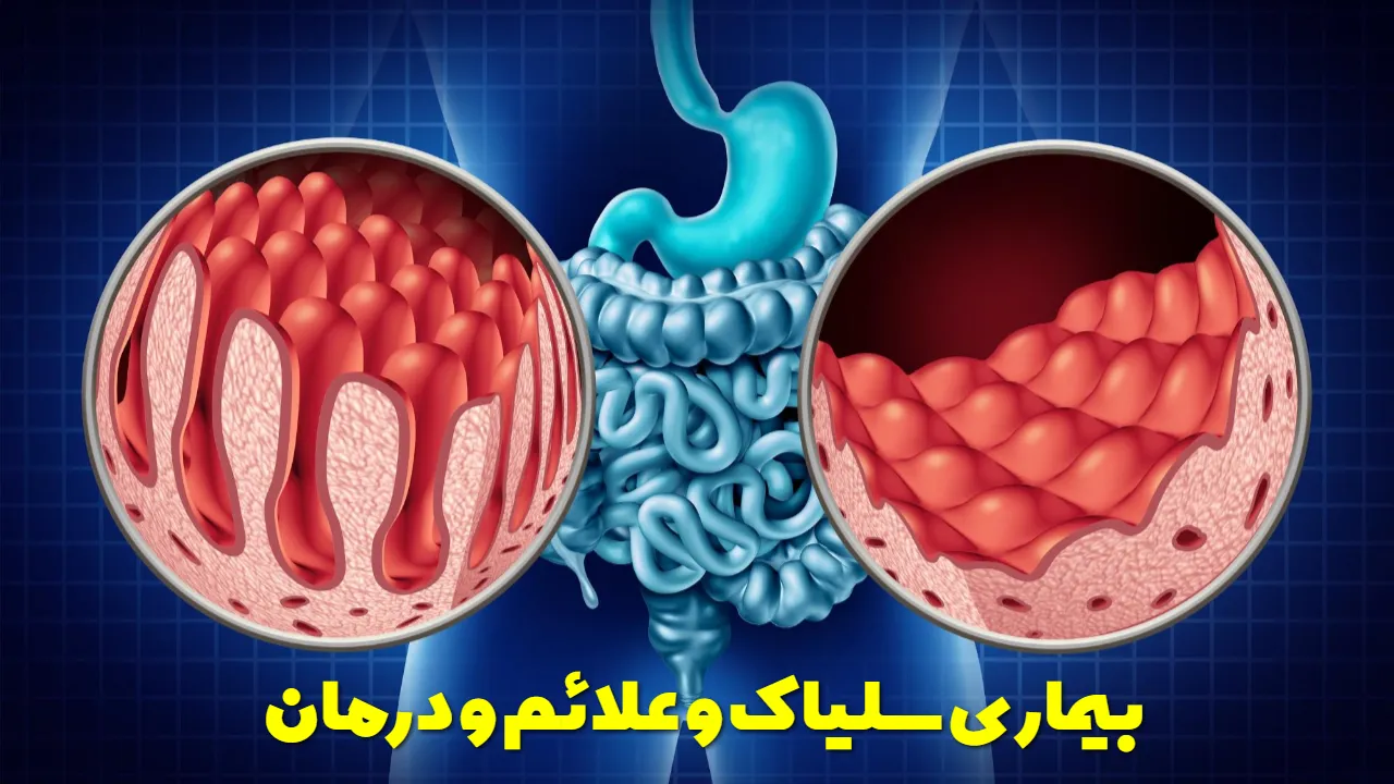 بیماری سلیاک و علائم و درمان