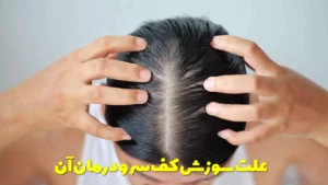 علت سوزش کف سر و درمان آن