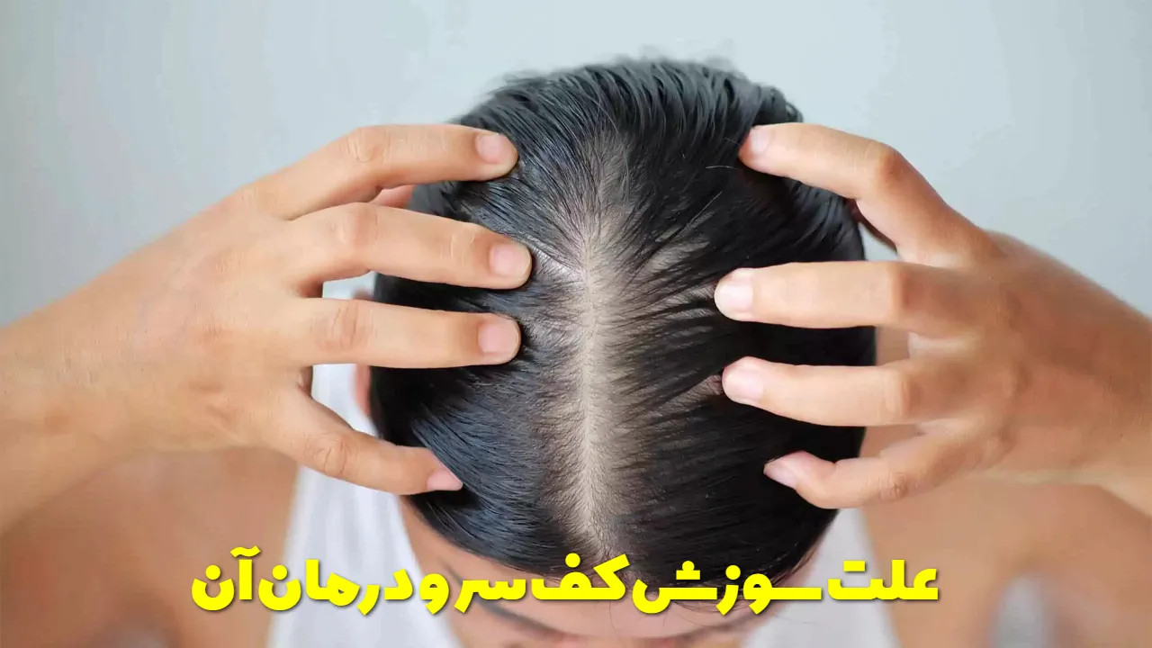 علت سوزش کف سر و درمان آن