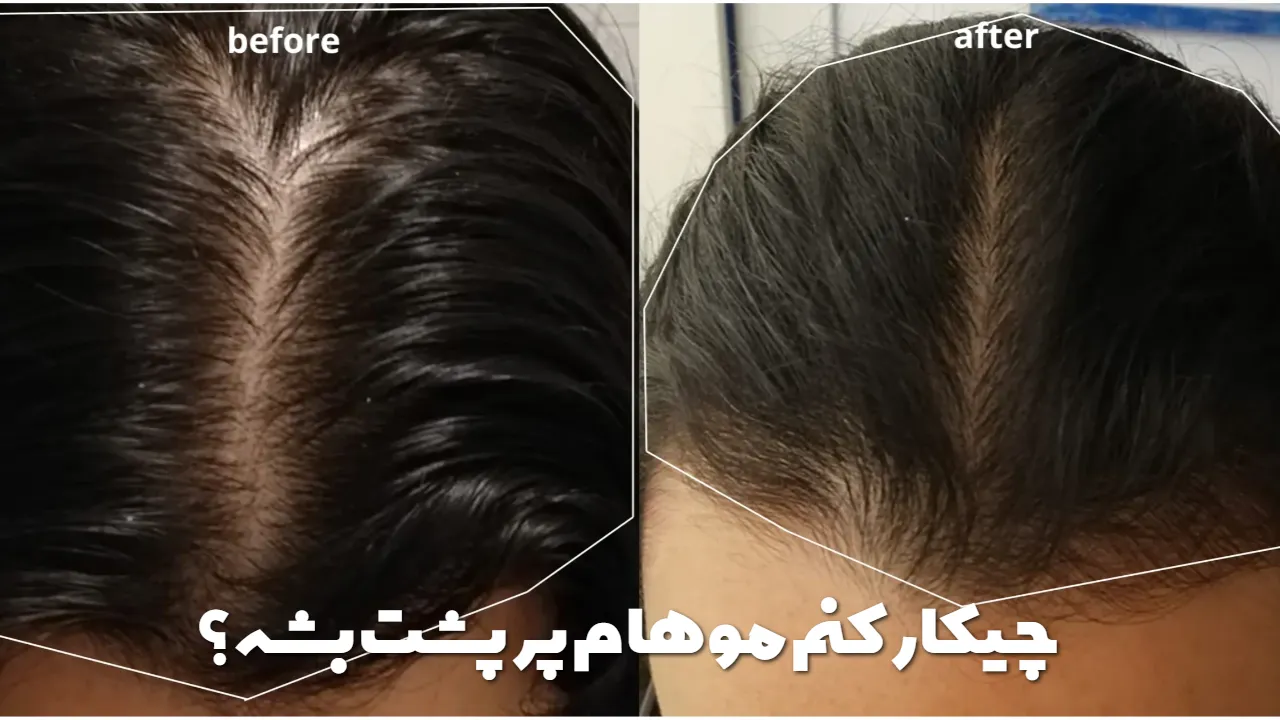 چیکار کنم موهام پرپشت بشه؟