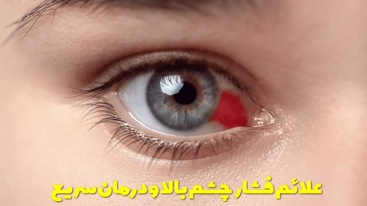 علائم فشار چشم بالا + درمان سریع