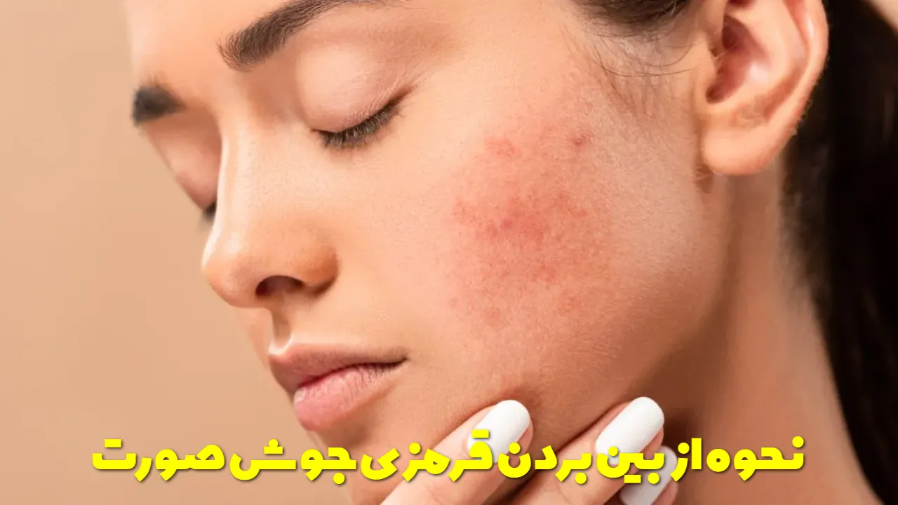 نحوه از بین بردن قرمزی جوش صورت