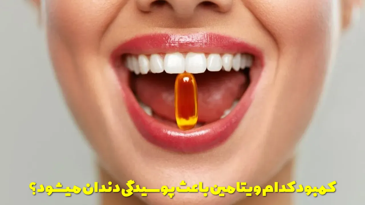 کمبود کدام ویتامین باعث پوسیدگی دندان میشود؟