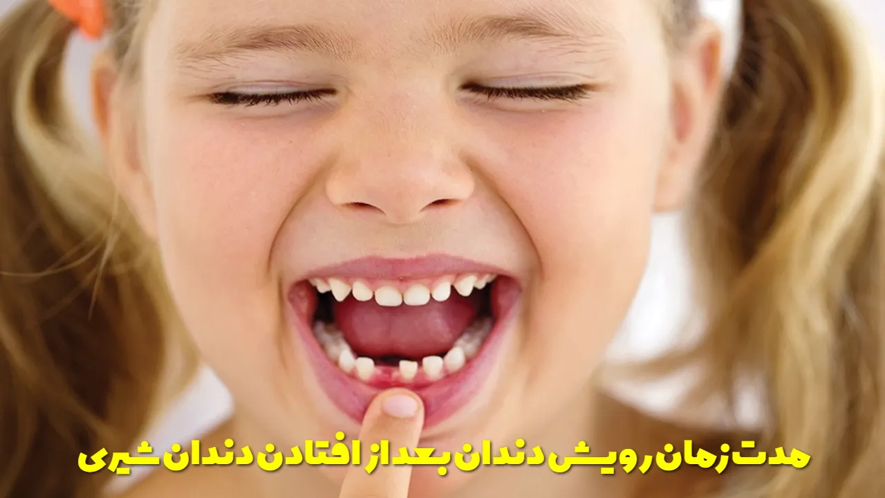 مدت زمان رویش دندان دائمی بعد از افتادن دندان شیری