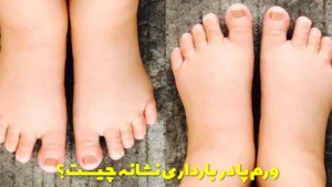 ورم پا در بارداری نشانه چیست؟