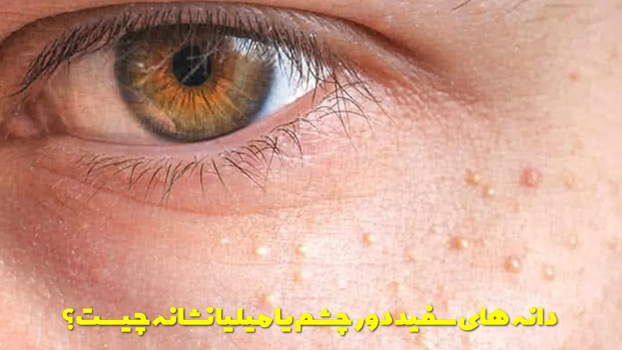 دانه های سفید دور چشم یا میلیا نشانه چیست؟