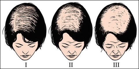 ریزش موی ارثی یا هورمونی