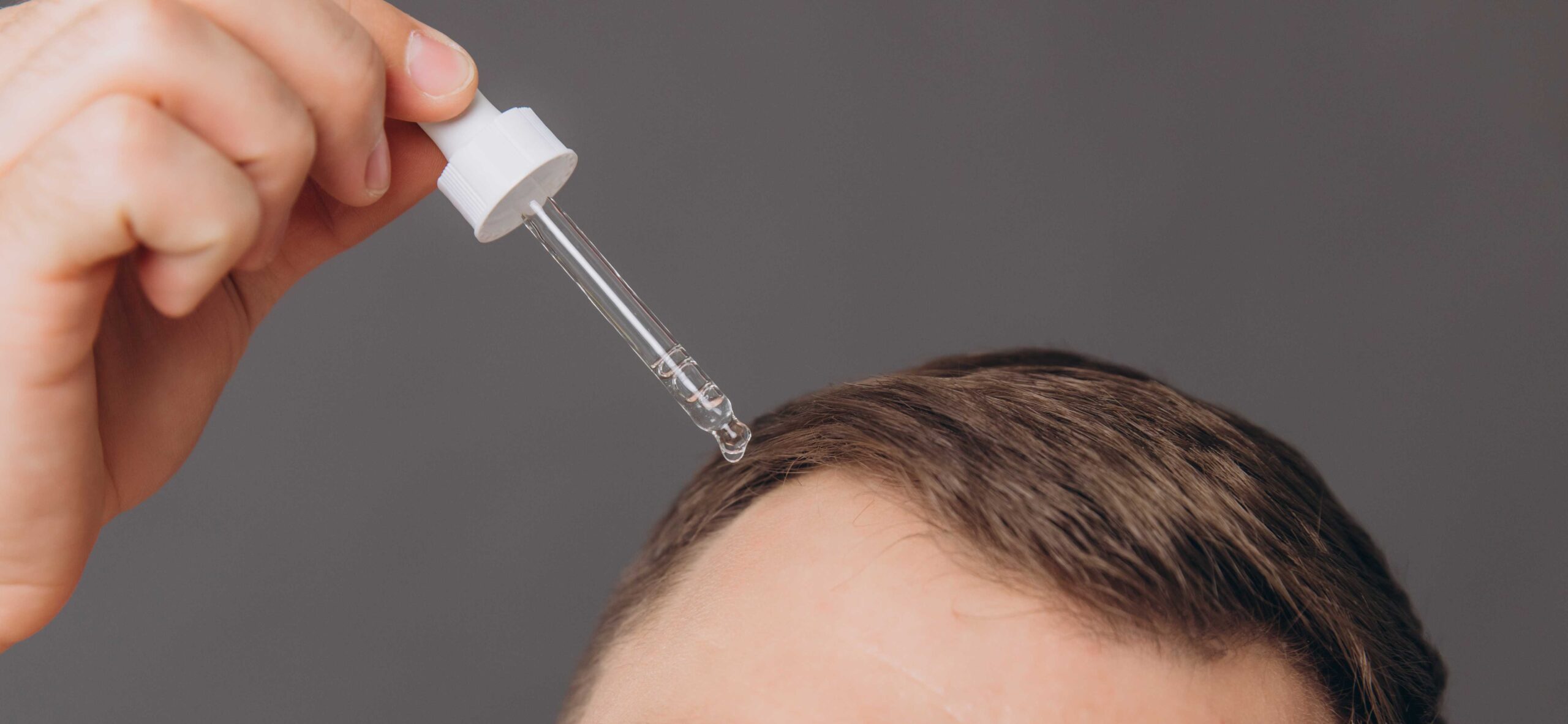 ریزش موی ارثی یا هورمونی