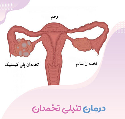 روش های اصلاح سبک زندگی برای بارداری و رفع تنبلی تخمدان