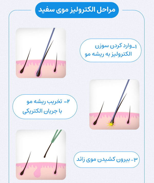 الکترولیز موهای سفید