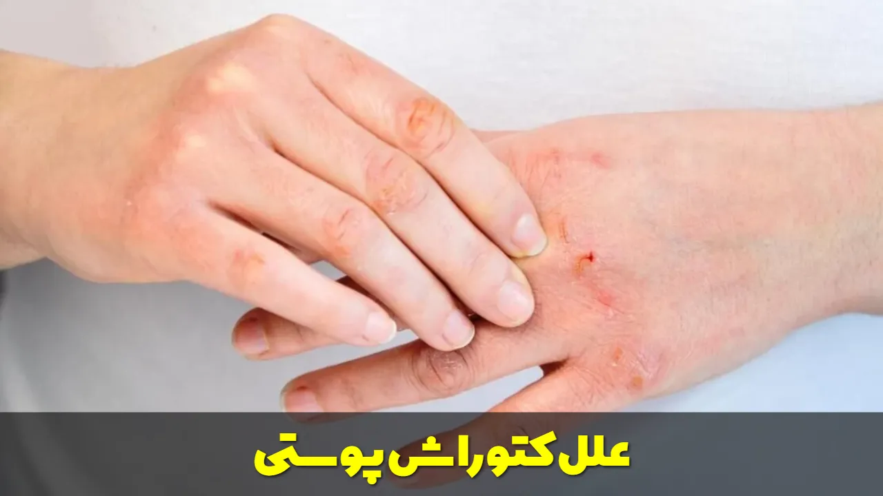 علل کتوراش پوستی