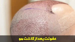 عفونت بعد از کاشت مو
