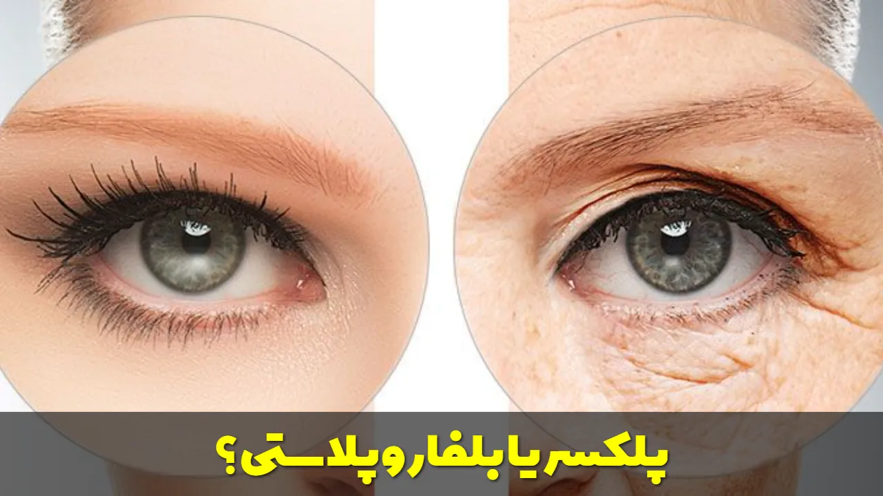 پلکسر یا بلفاروپلاستی؟