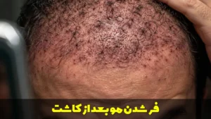فر شدن مو بعد از کاشت