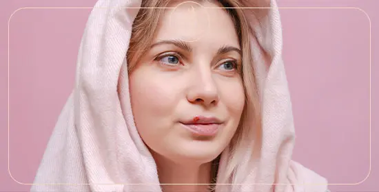 تبخال بعد از تزریق ژل لب