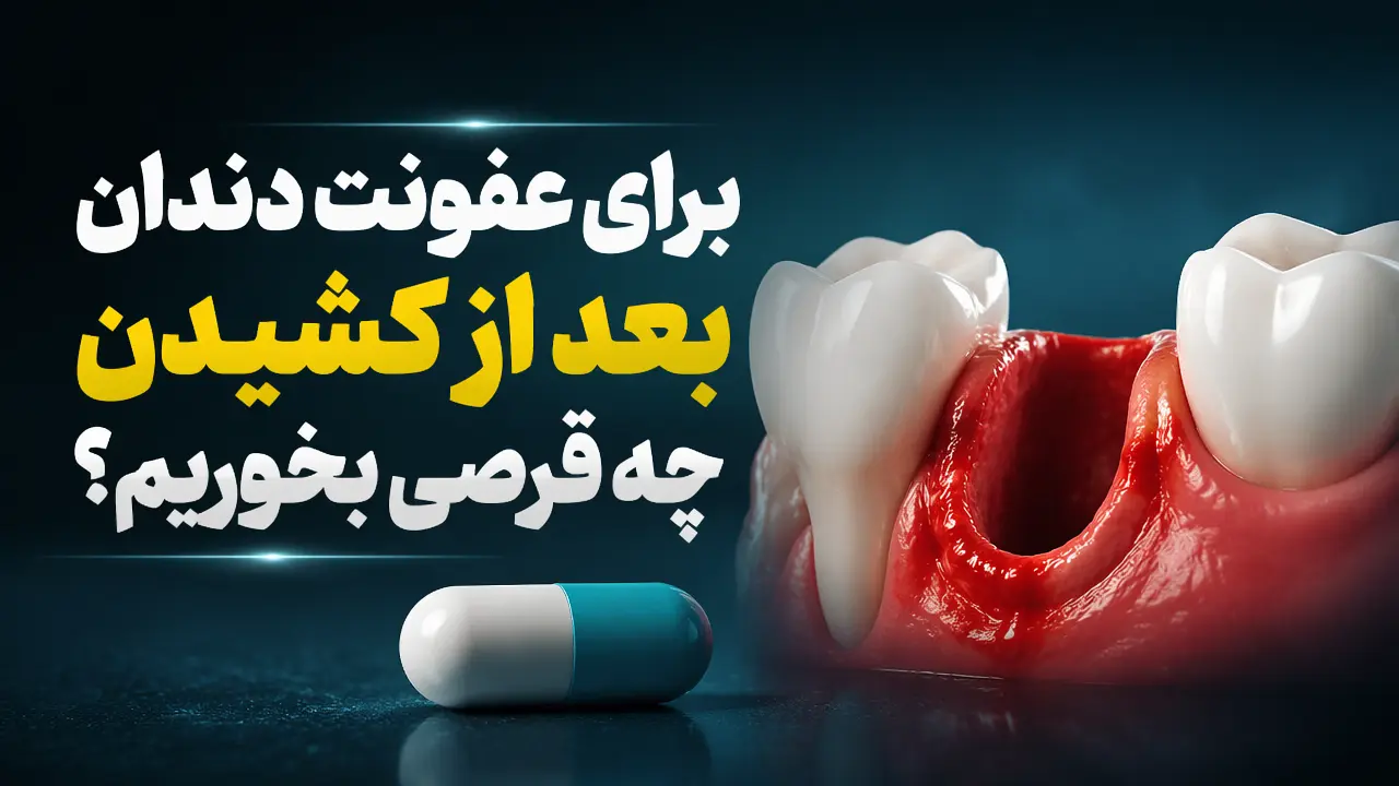 برای عفونت دندان بعد از کشیدن چه قرصی بخوریم؟