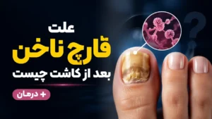 علت قارچ ناخن بعد از کاشت چیست + درمان