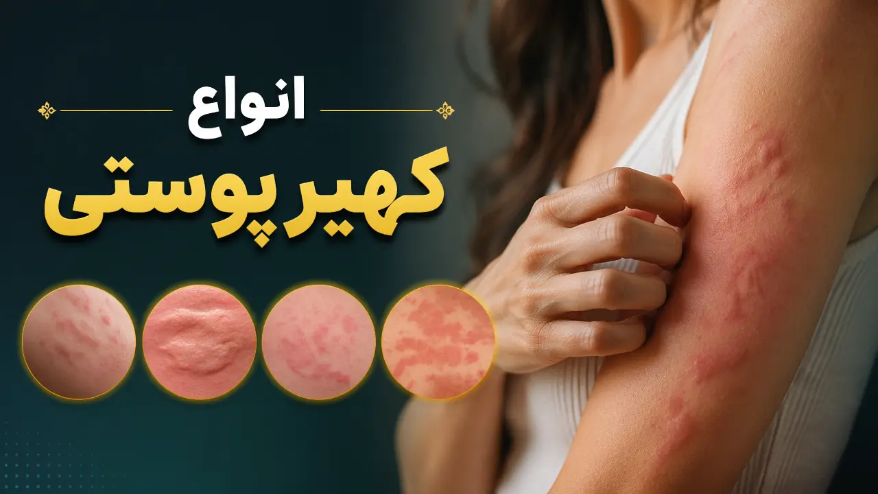انواع کهیر پوستی
