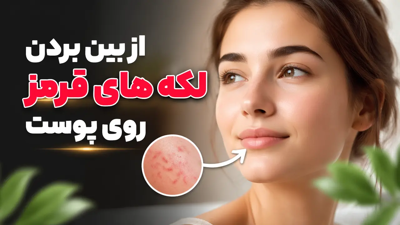 از بین بردن لکه های قرمز روی پوست
