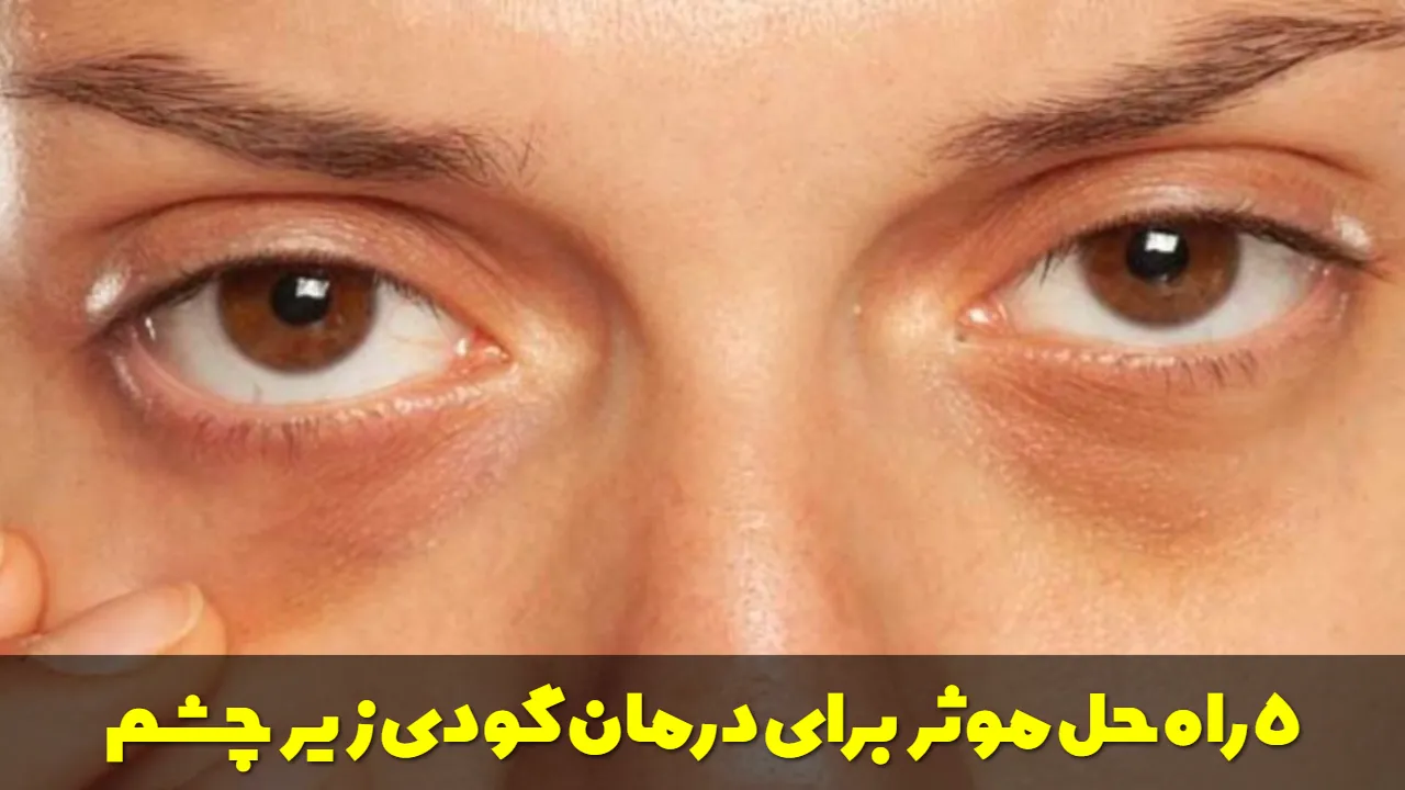 ۵ راه حل موثر و اثبات شده برای درمان گودی زیر چشم