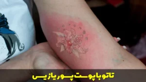 تاتو با پوست پسوریازیس