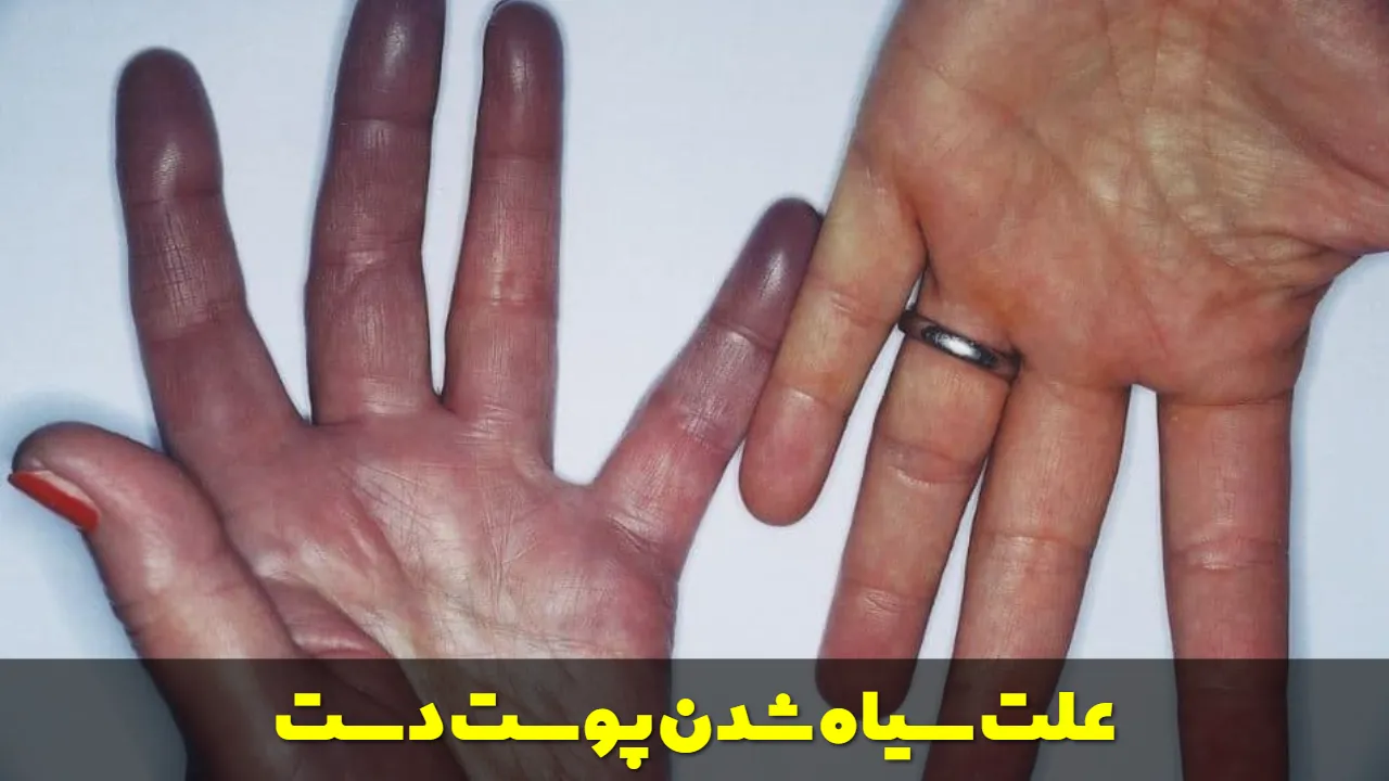 علت سیاه شدن پوست دست