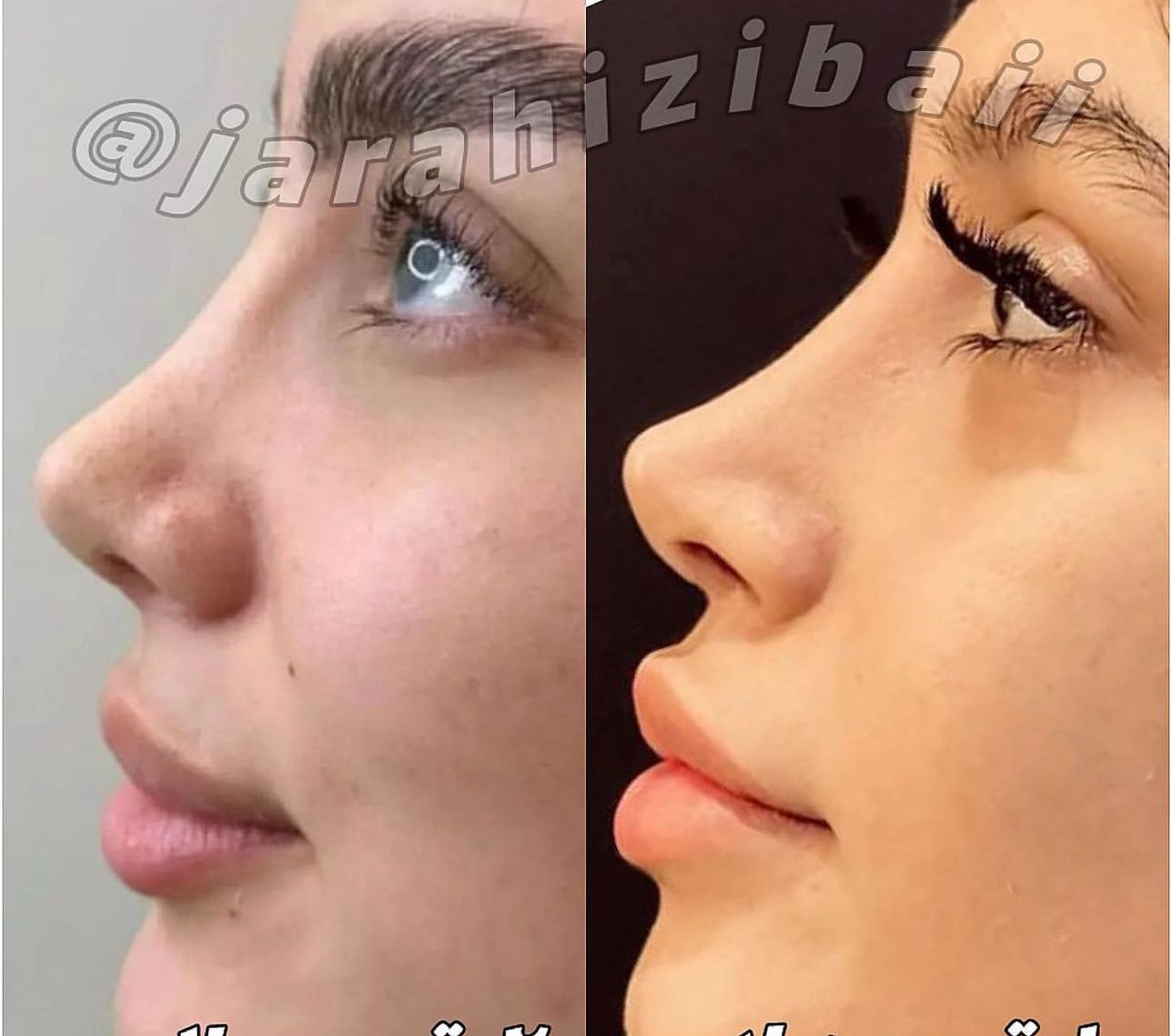 مدل بینی عروسکی