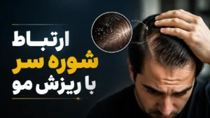 ارتباط شوره سر با ریزش مو