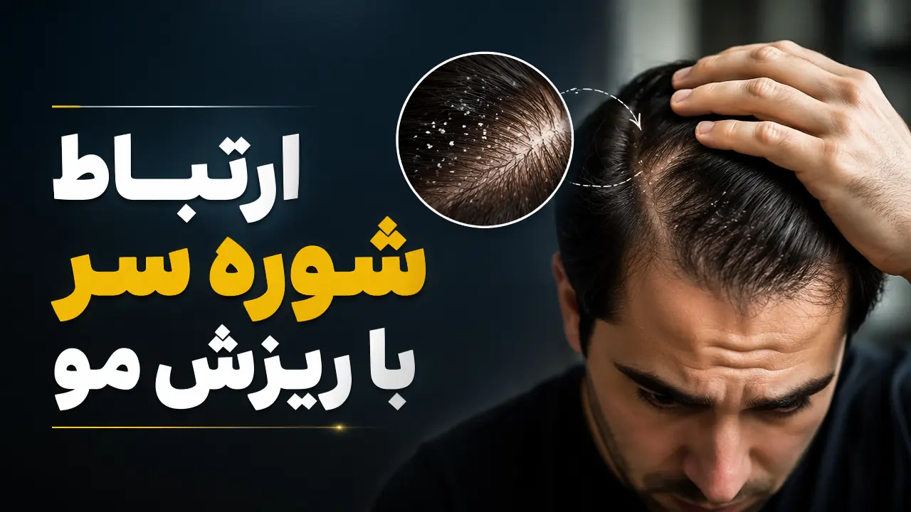 ارتباط شوره سر با ریزش مو